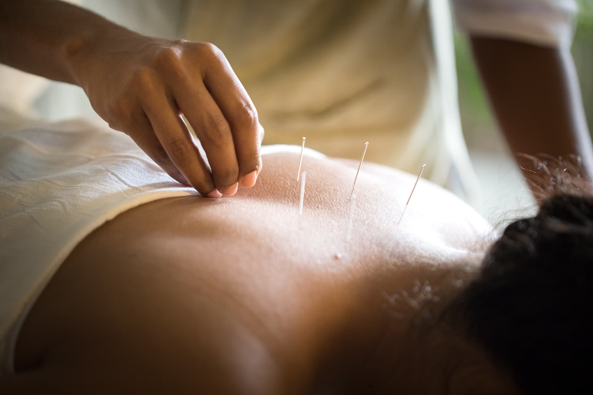 Therapist placing fine acupuncture needles during a treatment at Prakriti Shakti, Kerala